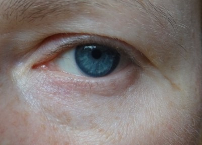PaloviaLeftEyeBefore