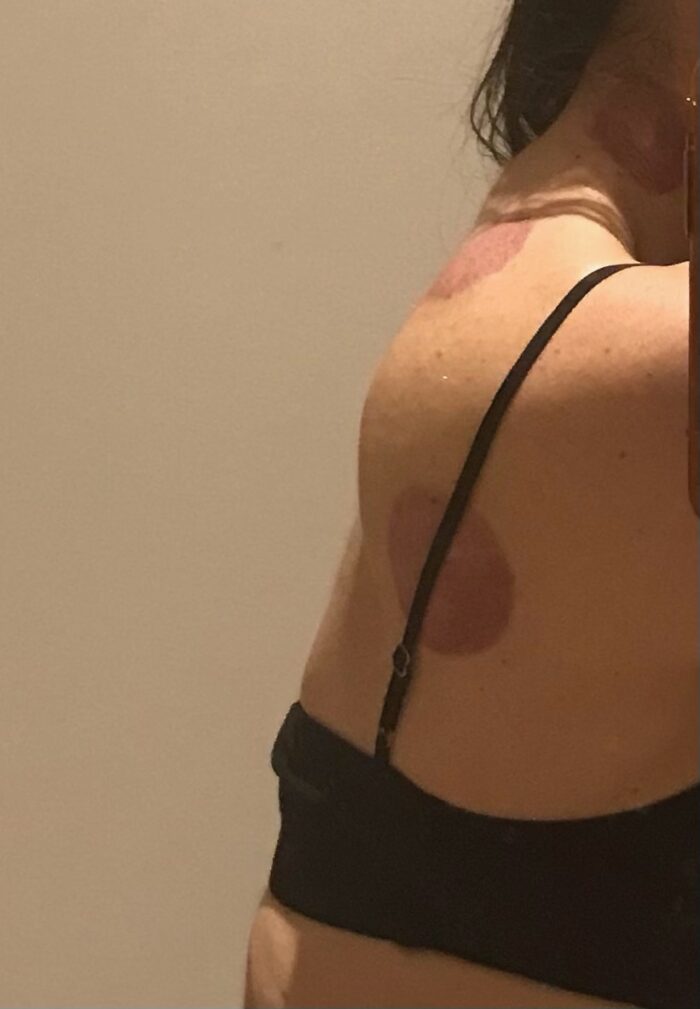 cupping marks